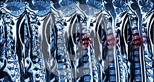 Cervical spondylosis with disc herniation ( MRI of cervical spine : show cervical spondylosis with disc herniation compress spinal