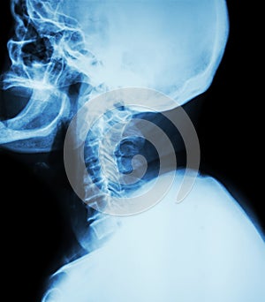 Cervical spondylosis . Film x-ray of cervical spine ( lateral position ) ( side view )