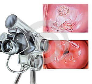 Cervix - Abnormal Colposcopy