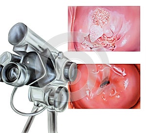 Cervix - Abnormal Colposcopy photo