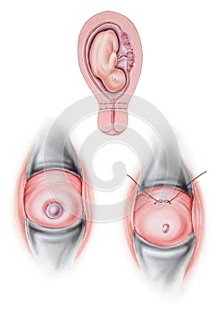 Cervix - Cervical Cerclage photo