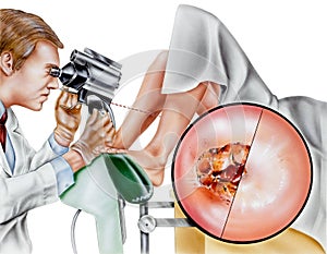 Cervix - Cervical Laser Surgery