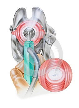 Cervix - Cryosurgery of Cervical Lesions