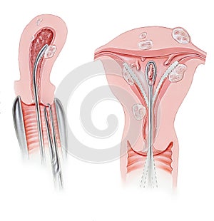 Cervix - Dilation and Curettage D&C Procedure