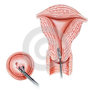 Cervix & Endocervix - Biopsy photo