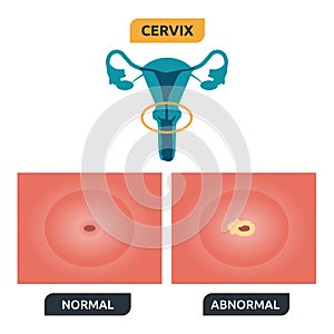 Cervix