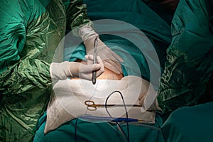 Cesarean Section in Progress: A Glimpse Inside the Operating Room