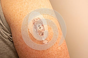 CGM - Continuous glucose monitoring:  sensor installation on the upper arm. Sensor pod and transmitter latch
