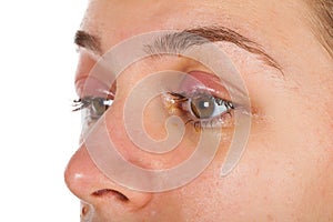 Chalazion - Eyelid infection photo