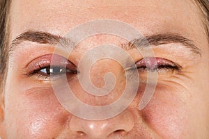 Chalazion - Eyelid infection photo