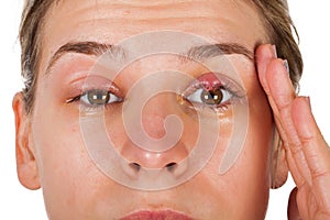 Chalazion - Eyelid infection photo