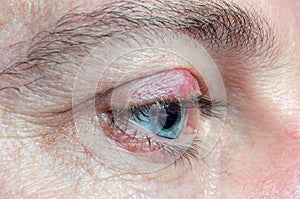 Chalazion on the eyelid of a man close-up photo