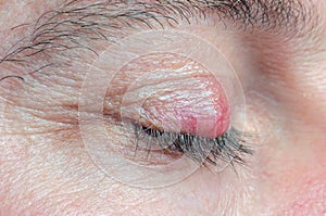 Chalazion on the eyelid of a man close-up photo