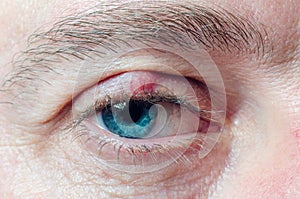 Chalazion on the eyelid of a man close-up