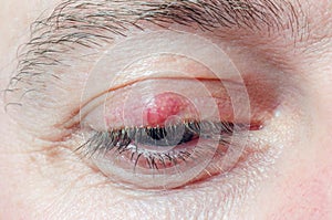 Chalazion on the eyelid of a man close-up photo