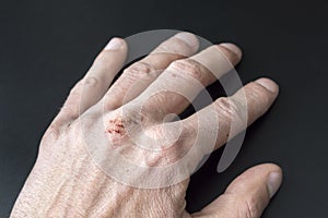 Chapped hands from cold weather, dry cracked knuckles