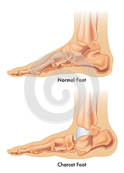 Charcot foot