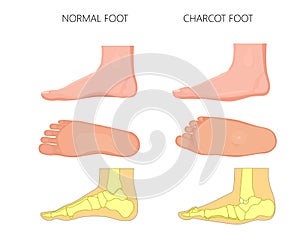 Charcot foot photo