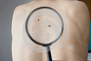 Checking melanoma on the back of a man
