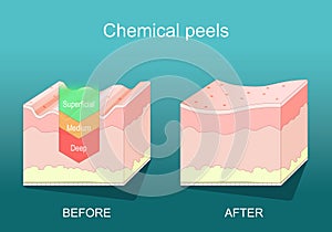 Chemical peel. Beauty aesthetic treatment