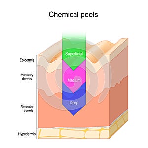 Chemical peel. Skin layers