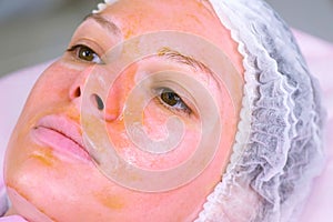 Chemical peeling o the woman`s face. Cleaning the face skin and lightening freckles skin. Close-up face.