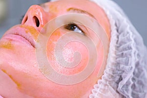 Chemical peeling o the woman`s face. Cleaning the face skin and lightening freckles skin. Close-up face. Side view.