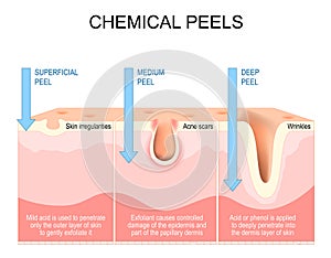 Chemical peels. Exfoliation photo