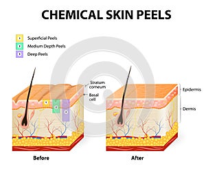 Chemical peels photo