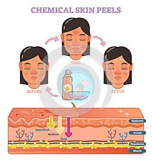 Chemical skin peels vector illustration diagram