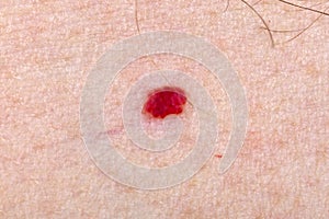 Cherry angioma on human skin