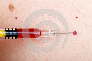 Cherry angioma and nevus