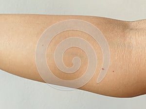 Cherry Angiomas Red mole, Red mark on arm skin, Red dot suddenly appeared. Cherry Hemangioma on arm