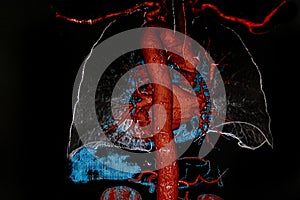 Chest angiography. 3D rendering image. photo