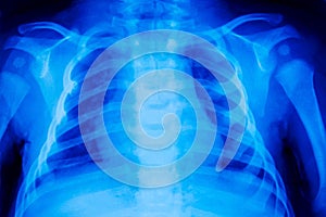 Chest cell x-ray.Roentgen of a small child.Concept of baby diagnosis.Old blurred shot