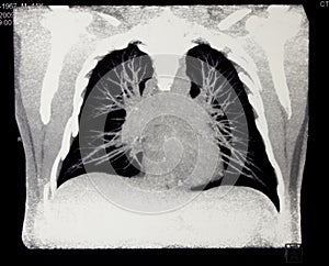 Chest, computed tomography