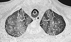 Chest CT Scan, Coronavirus pneumonia. Ground glass