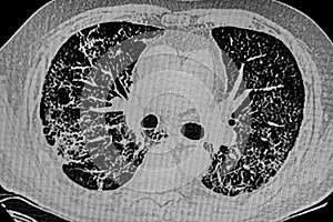 Chest CT Scan of Novel Coronavirus COVID-19