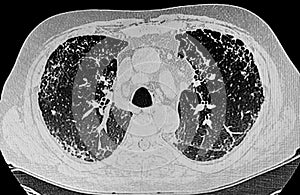 Chest CT Scan of Novel Coronavirus COVID-19