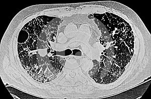 Chest CT Scan of Novel Coronavirus COVID-19 and right upper lobe cavitie.