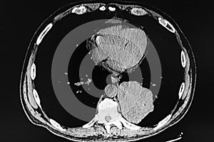 Chest CT Scan of patient with Squamous Cell Carcinoma