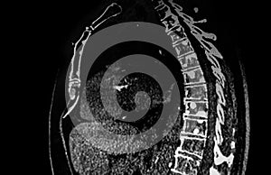 Chest CT Scan showing metastatic tumoral lesions on the vertebra photo