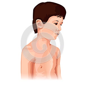 Chest deformation disorder type. Pectus carinatum. Marfan syndrome symptoms