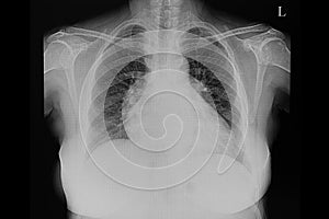 A chest film of a patient with cardiomegaly