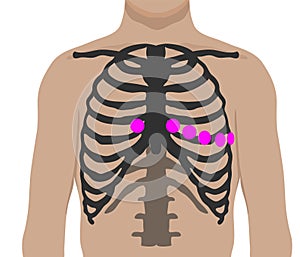 Chest leads placement. Ecg electrode position