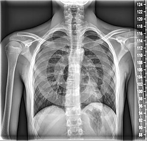 Chest Medical Xray, Lungs and Heart View