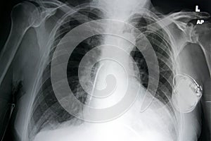 Chest+pacemaker photo