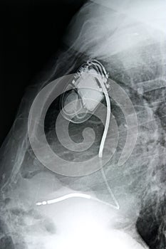Chest+pacemaker/side