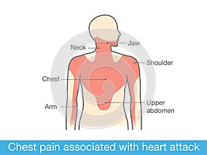 Chest pain associated with heart attack photo