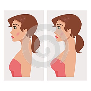 Chest before and after plastic. Vector Illustration